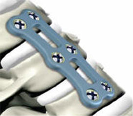 Anterior Cervical Discectomy with Fusion and Plate