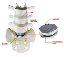Artificial cervical disc replacement that relieves neck and arm pain caused by a herniated disc or for preserving motion in the neck is a procedure offered by KBNI.