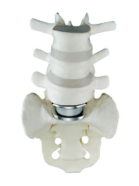 The Charite artificial disc is implanted between the L5 and the S1 vertebral levels. Between the cobalt alloy endplates of the Charite artificial disc, is seen the polyethylene core. The upper and lower surfaces of this core are spherical, and it is this design which provides for the non-constrained movement of the Charite artificial disc. The goal in this case, is to limit the "wear and tear" on the L4/L5 disc space.