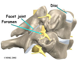 Cervical foraminotomy that relieves arm pain caused by nerve pressure in the spinal canal is a procedure performed at the KBNI.