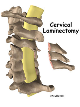 Cervical laminectomy surgery that relieves arm pain by removing pressure on the nerves in the neck due to thickened ligament and arthritis is a procedure performed by the KBNI.