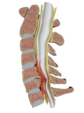 Spinal Stenosis