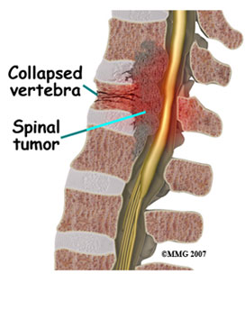 Spinal Tumors – Benign & Cancerous