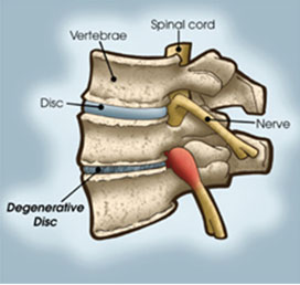 Degenerated disc disease causes pain in the low back, lower extremities, and arms, usually due to the general aging process, but can also result from trauma from an injury or even improper bending techniques.