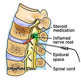 Epidural Steroid Injection