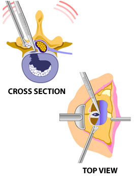 Foraminotomy