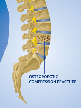 Kyphoplasty restores angulation and height of the spine and provides relief for back pain from osteoporosis, a treatment performed by KBNI.