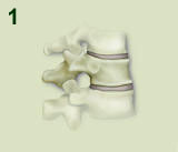 Kyphoplasty Procedure Step 1