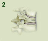 Kyphoplasty Procedure Step 2