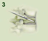 Kyphoplasty Procedure Step 3