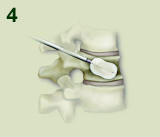 Kyphoplasty Procedure Step 4