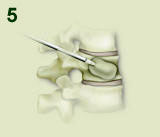 Kyphoplasty Procedure Step 5
