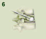 Kyphoplasty Procedure Step 6