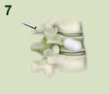 Kyphoplasty Procedure Step 7