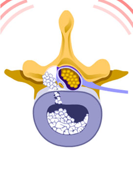 Lumbar Discectomy Surgery/Microdiscectomy relieves pressure on a nerve in the low back caused by a herniated disc. It is one option for herniated disc surgery performed by KBNI.