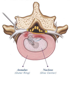 A lumbar endoscopic discectomy relieves back pain by removing a portion of the disc and decompress nerves in the lumbar spine.