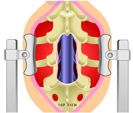 lumbar laminectomy