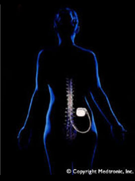 Spinal cord stimulation is one of the most successful techniques available for the treatment of intractable chronic pain syndromes of benign origin.