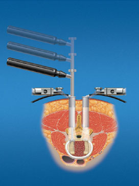 Instrumentation used in minimally invasive approach for a fusion including the tubular retractor, through which the surgery is performed.