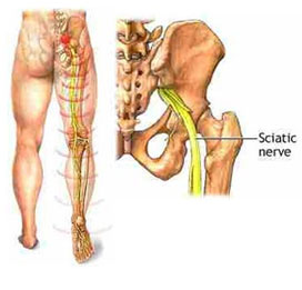 Sciatica symptoms, causes, diagnosis and treatments by the spine specialists at KBNI.