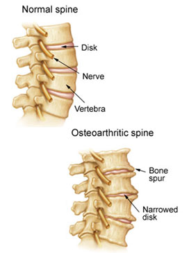 Spinal Arthritis occurs in the facet joints (also called vertebral joints) that connect vertebrae, a condition treated by the spinal arthritis specialists at KBNI.