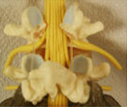 Spinal Lamina Removed from Spine 