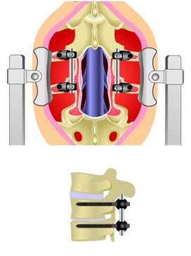 Spinal lumbar fusion
