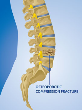 Osteoporotic Fracture – Condition Treated by the Kraus Back & Neck Institute