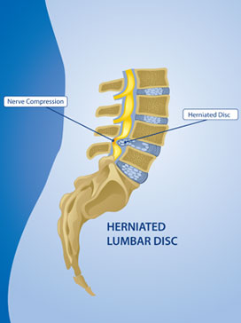 Herniated Disc Treatment