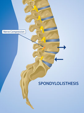 Spondylolisthesis